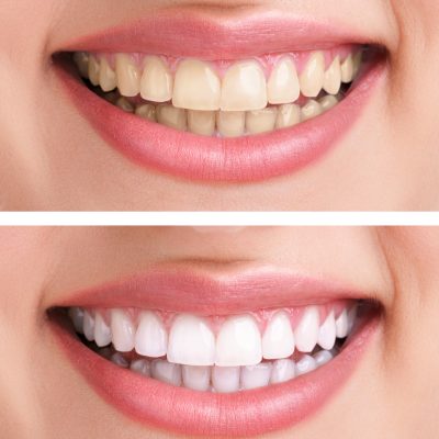 whitening - bleaching treatment ,before and after ,woman teeth and smile, close up, isolated on white